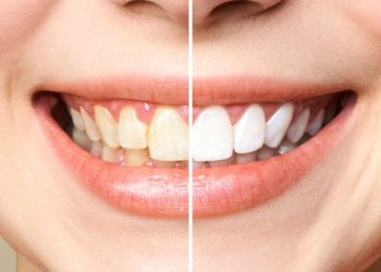 What is fluorosis?