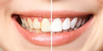 What is fluorosis?