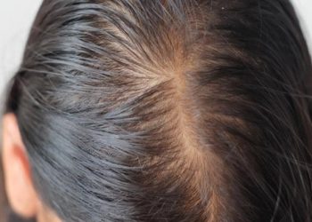 Hair Loss in Women: What Causes the Issue?