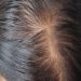 Hair Loss in Women: What Causes the Issue?