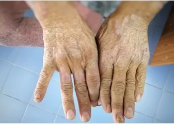 Scleroderma