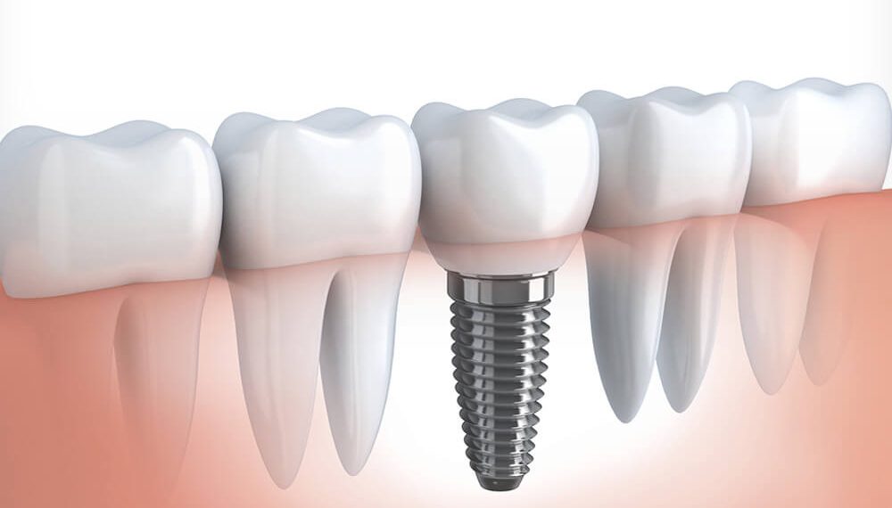Dental Implants: How To Find The Best Dental Clinic In Pestera Brasov