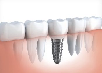 Dental Implants: How To Find The Best Dental Clinic In Pestera Brasov