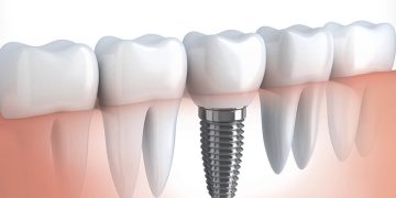 Dental Implants: How To Find The Best Dental Clinic In Pestera Brasov