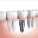 Dental Implants: How To Find The Best Dental Clinic In Pestera Brasov