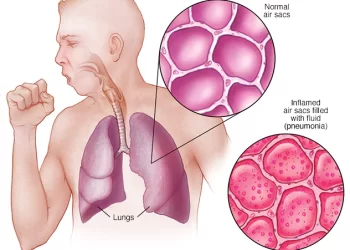 Diagnosis And Treatment Of Pneumonia 
