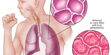 Diagnosis And Treatment Of Pneumonia 
