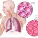 Diagnosis And Treatment Of Pneumonia