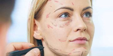 Everything You Need To Know About Facelift Surgery