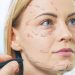 Everything You Need To Know About Facelift Surgery
